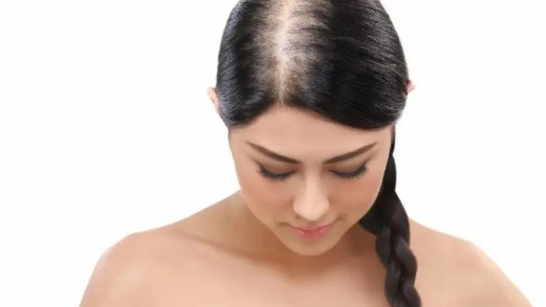 Sempre più donne soffrono di L'alopecia androgenetica