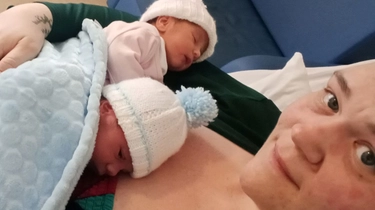 Mamma dà alla luce due gemelli simultanei: il raro parto in Scozia