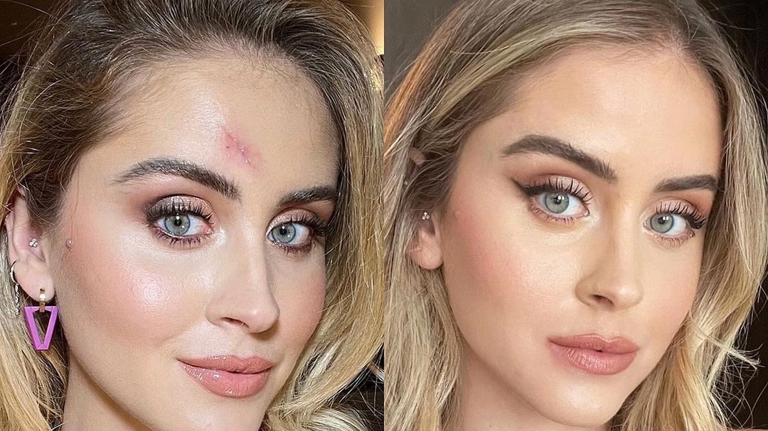 Valentina Ferragni, prima e dopo l'intervento per rimuovere un carcinoma basocellulare sul volto (Instagram)