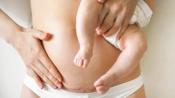Closeup of woman belly with a scar from a cesarean section. Woman with baby on hand