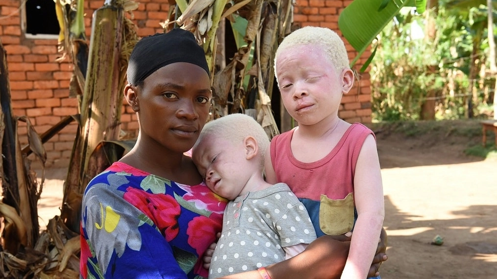 albinismo Uganda Cbm Italia