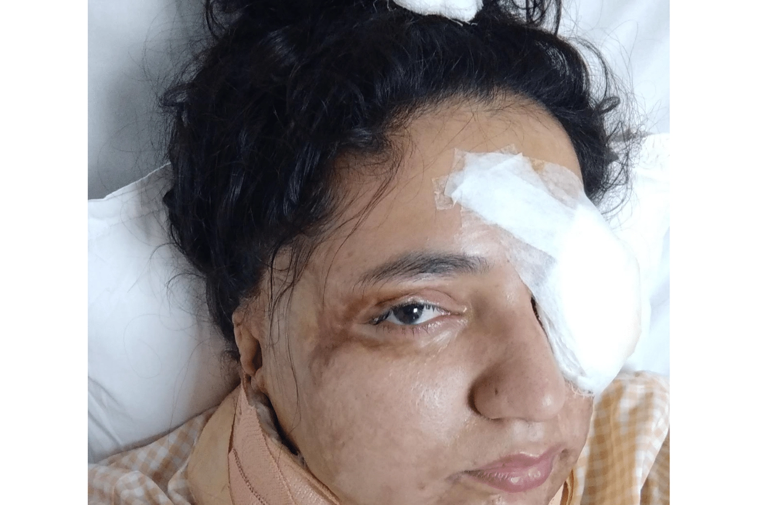 La vittima di violenza con l'acido in India