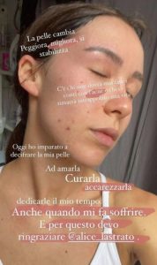 Aurora Ramazzotti parla di acne sui suoi profili social