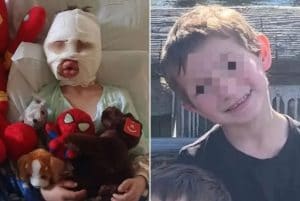 Il piccolo Dominick Krankall prima e dopo l’incidente in due delle immagini pubblicate dalla famiglia