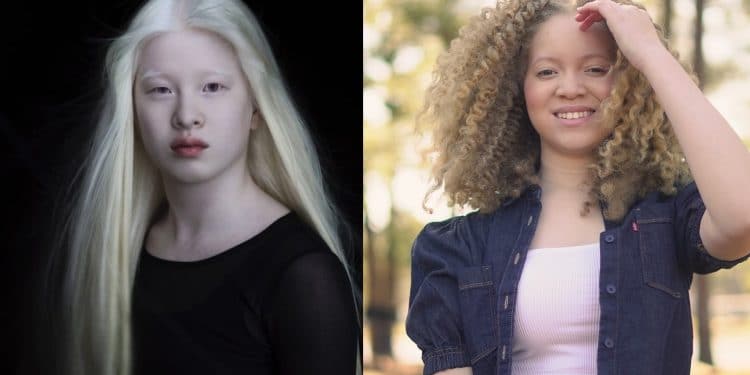 Xueli Abbing e Ava Clarke, entrambe modelle, sono albine