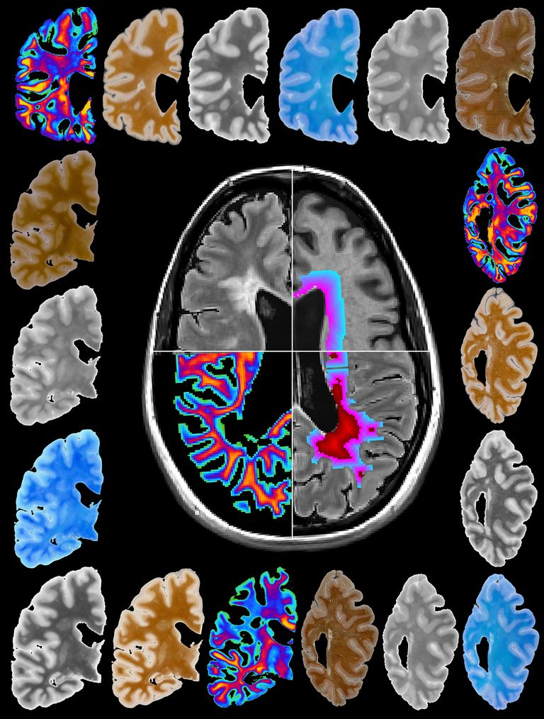 Patologia della sclerosi multipla in vivo ed ex vivo Russel Ouellette, Department of Clinical Neuroscience, Department of Neuroradiology, Karolinska Institutet Courtesy Karolinska Institutet, Stockholm, Sweden