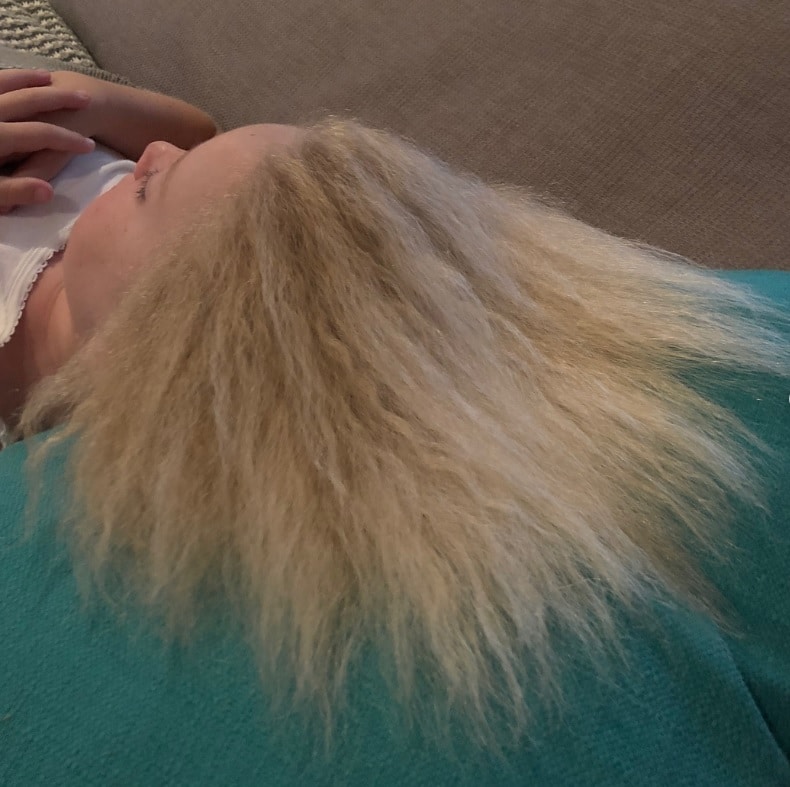 Shilah Madison soffre della sindrome dei capelli incontrollabili (UHS), patologia molto rara che li fa crescere ‘sparati’ verso l’esterno