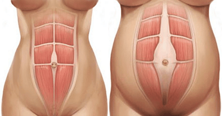 La diastasi addominale è la separazione eccessiva della parte sinistra e dalla parte destra del muscolo retto addominale
