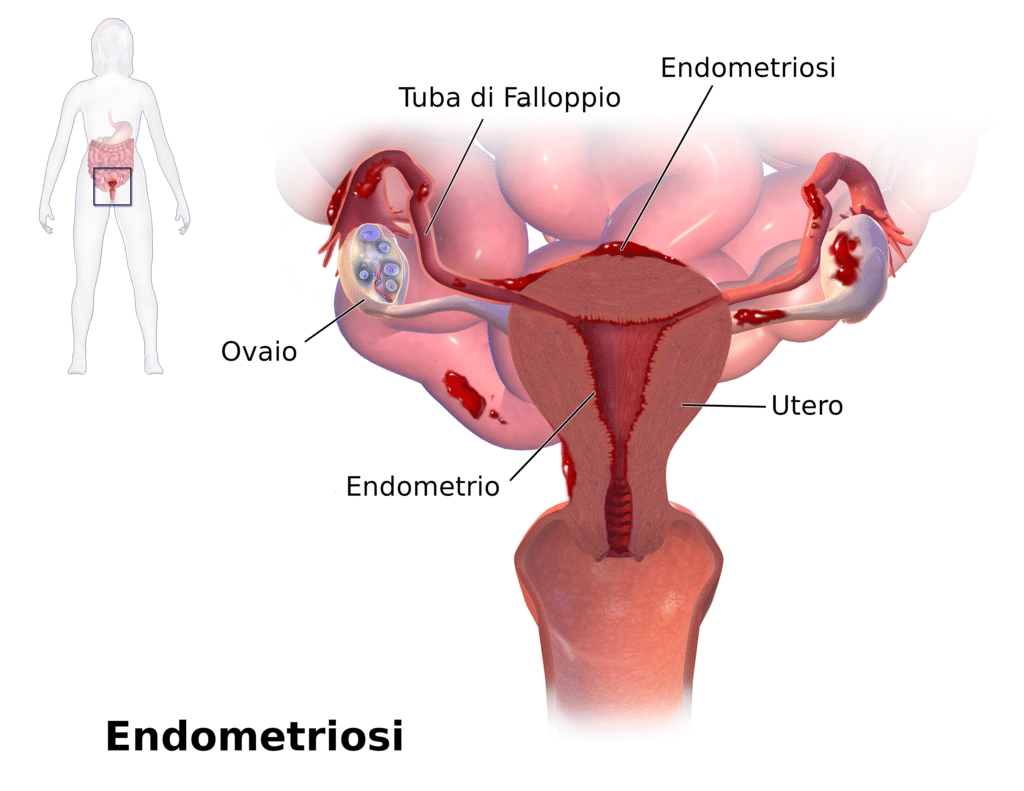 Illustrazione che descrive un caso di endometriosi (Wikipedia)