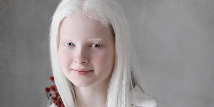 amina ependieva albinismo eterocromia