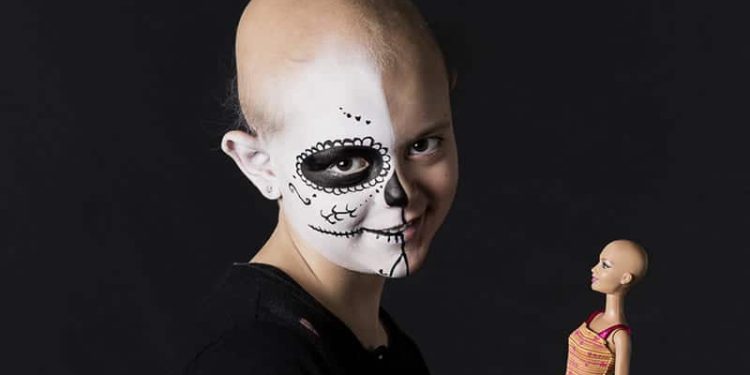 alopecia-areata-mostra