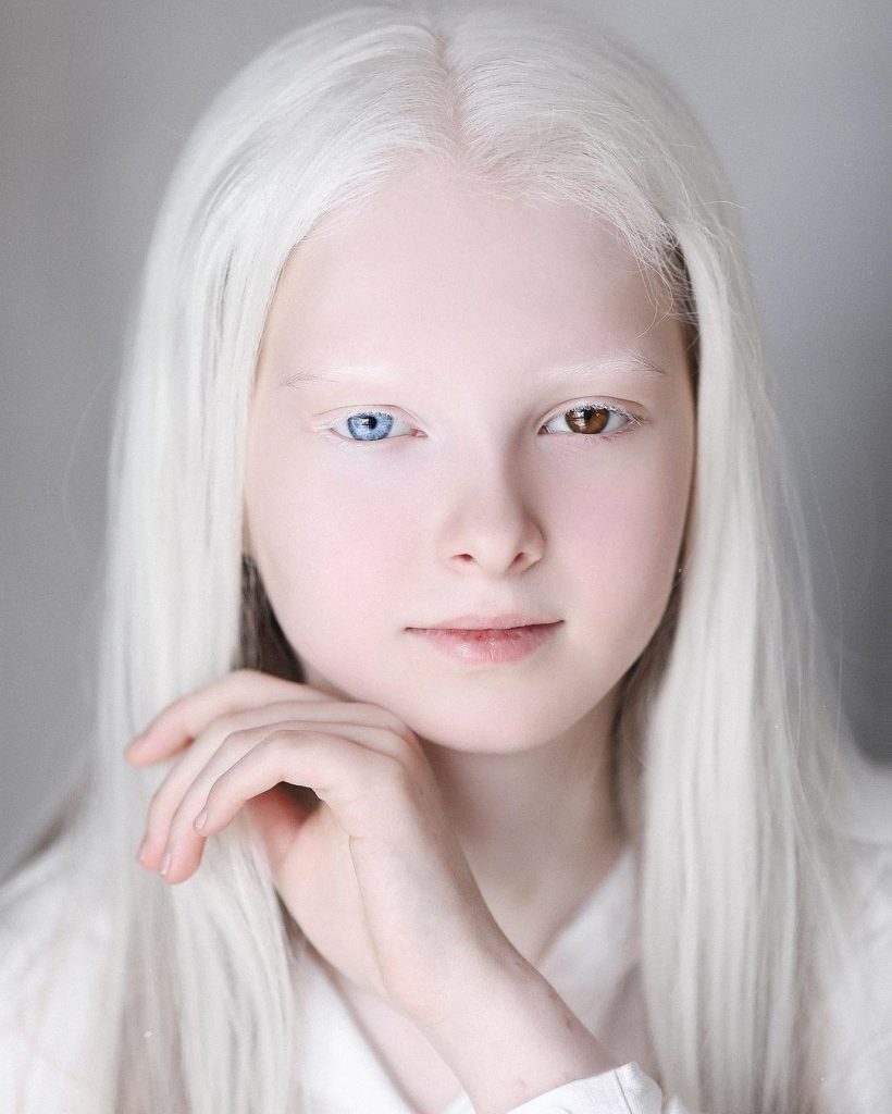 amina ependieva albinismo eterocromia
