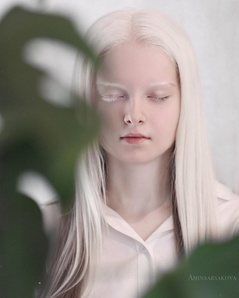 Amina Ependieva albinismo eterocromia