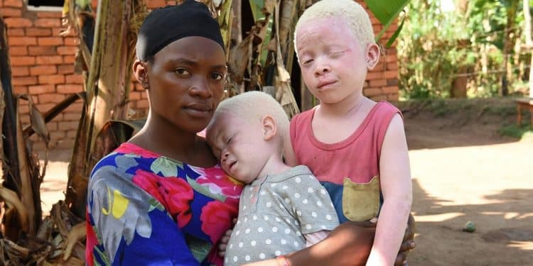 giornata-albinismo-stigma-cure